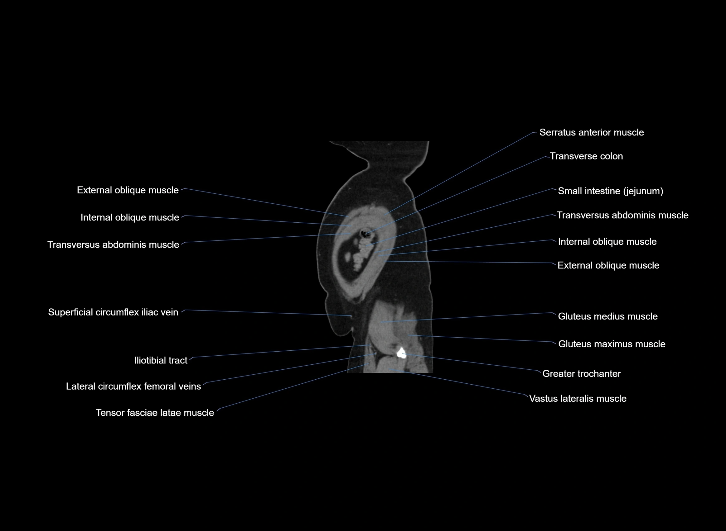 CT Abdomen sagittal cross sectional anatomy labelled radiology image -00009.webp